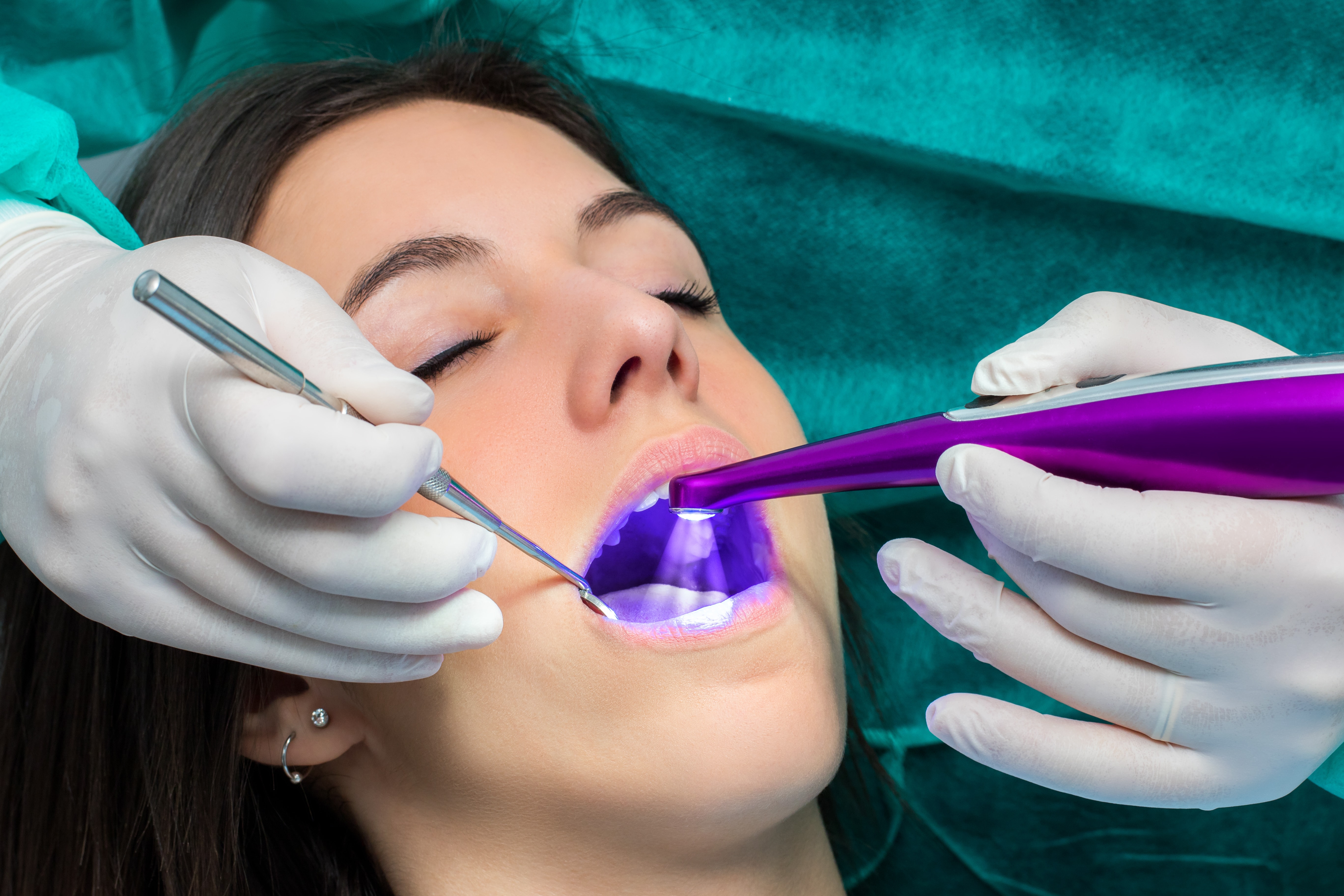 Dentist applying dental sealant