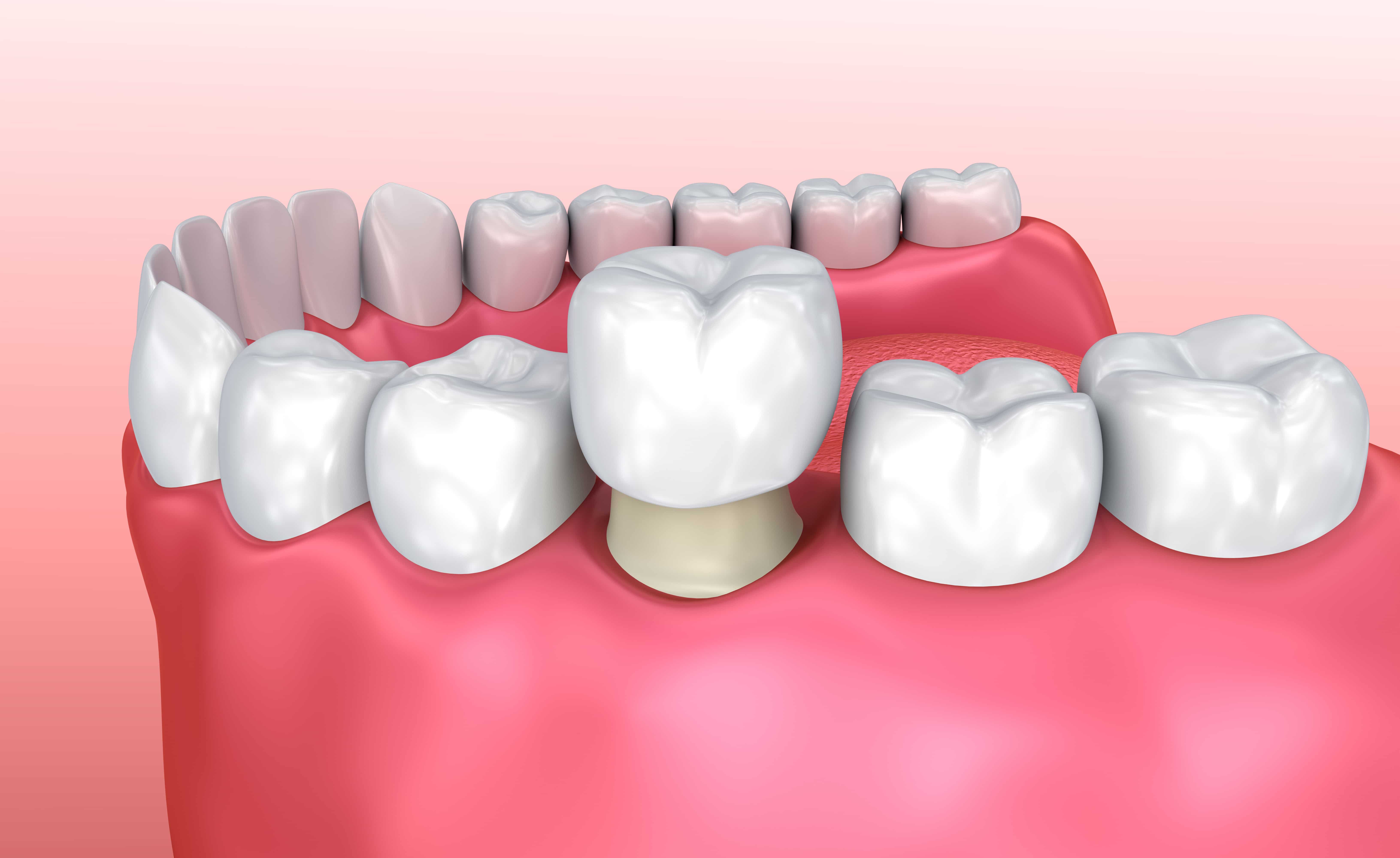 Dental Crown Ellis Dentistry