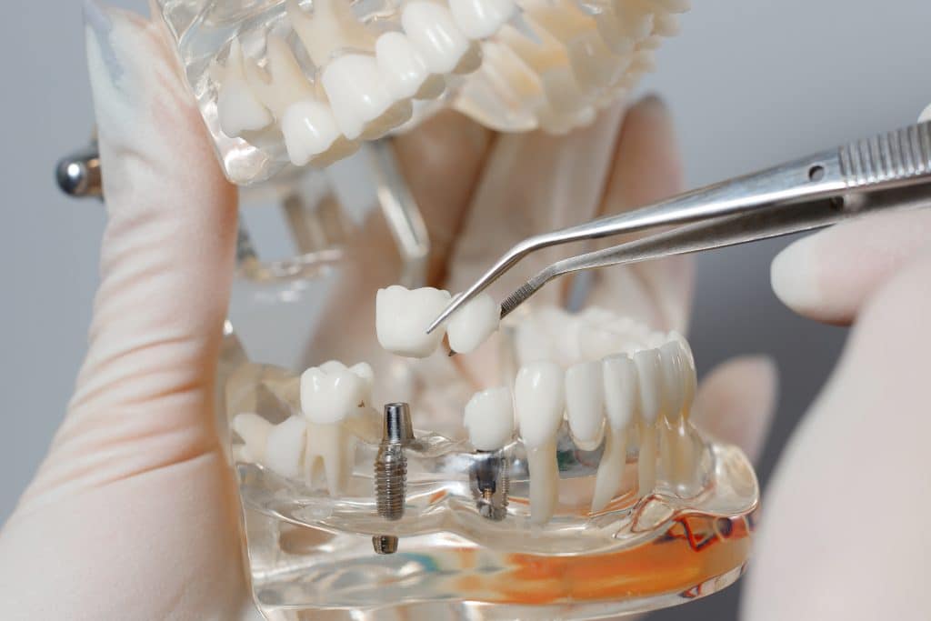 Dental Implants w/ Flexible Payment Options Everson, WA
