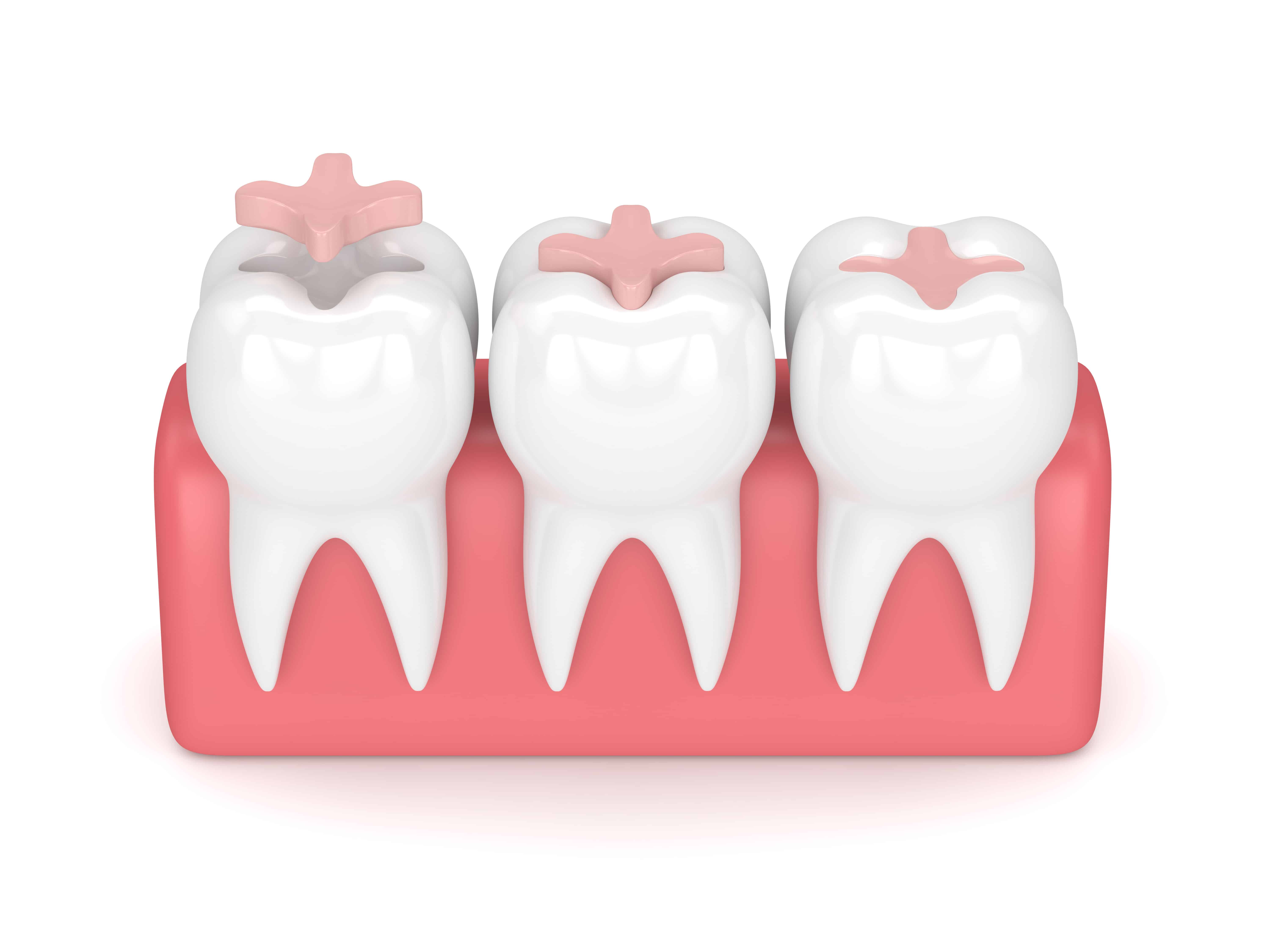 Dental Inlay 3D image